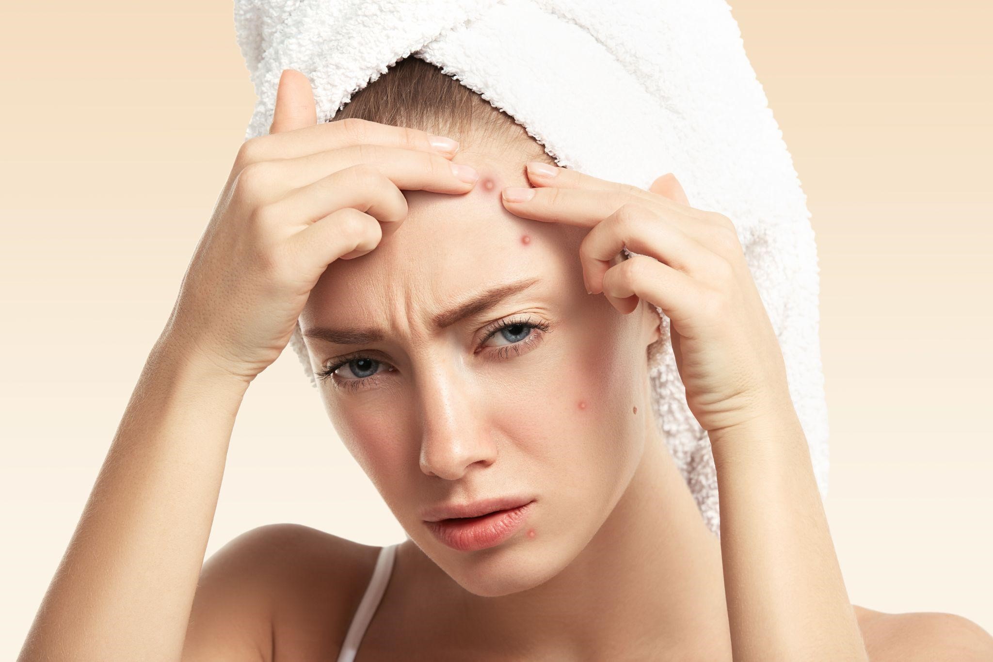 7 Tips Mencegah Jerawat Muncul di Wajah Setiap Hari